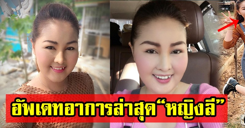 สู้ต่อไป "หญิงลี" อัพเดทอาการล่าสุด "หน้าตาและแขนขาเป็นแบบนี้แล้ว ? (ชมภาพ)