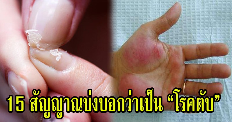 เรื่องใกล้ตัว ระวังให้มาก !! 15 สัญญาณบ่งบอกว่าเป็นโรคตับ รีบเช็คด่วน ก่อนสายเกินแก้ !! (รายละเอียด)