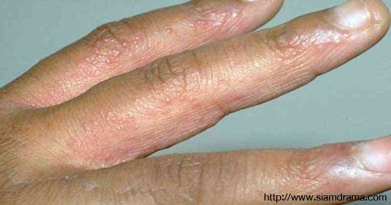 เช็คด่วน!! ภัยใกล้ตัว "ตุ่มใสๆ บนฝ่ามือ ฝ่าเท้า" สัญญาณเตือนโรคร้าย ที่หลายคนไม่เคยรู้มาก่อน!? รีบๆเลยก่อนสายเกินแก้!?