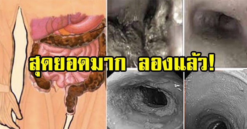 แชร์เก็บไว้เลย! เผย วิธีแก้อุจจาระไม่ออกอุจจาระแข็ง อุจจาระตกค้าง 2 วัน 3 วันจึงถ่ายครั้งหนึ่ง แค่ทำตามนี้ พุงยุบกันเลยที่เดียว!